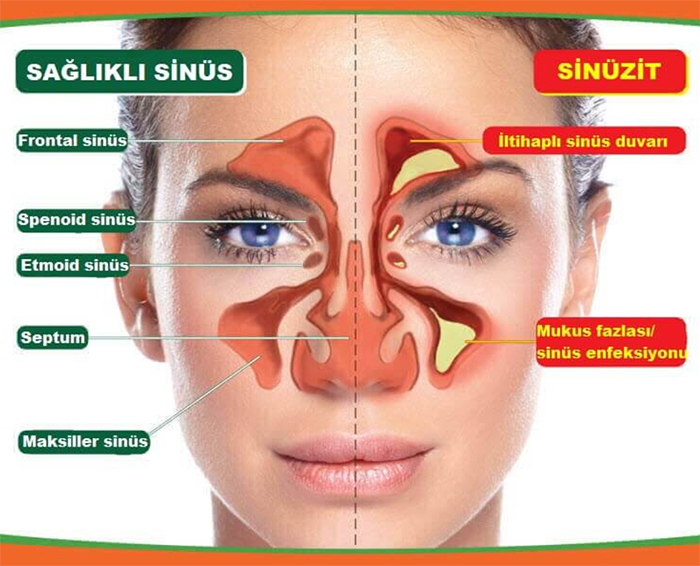 Sinüzit İçin En Etkili Burun Spreyleri ve İlaçlar